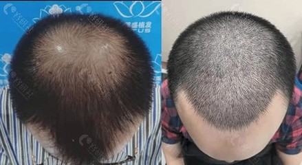 海口植发华美口碑好