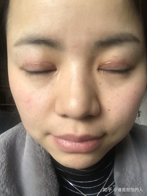 做全切双眼皮多久能化妆