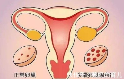 多囊会影响怀孕吗