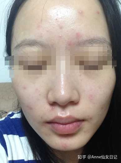 吃油长痘痘怎么办