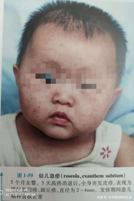 五个月宝宝出疹子怎么办