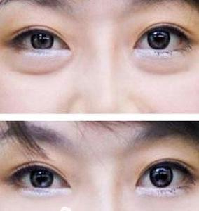 眼袋大是怎么回事