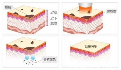 激光祛痣原理