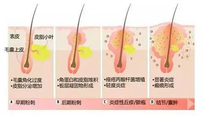 有痘痘的原因