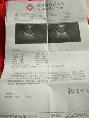 胎儿脐绕颈一周