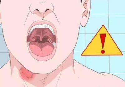 嗓子起白泡是怎么回事