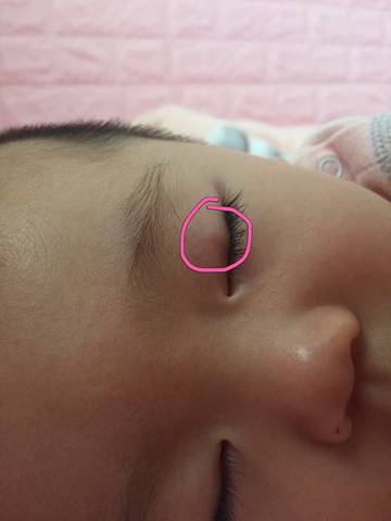 眼皮痘痘