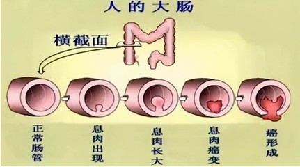 间位结肠怎么治疗