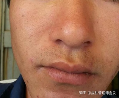 30岁痘痘一脸