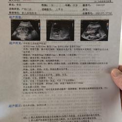 怎样检查胎儿是否缺氧