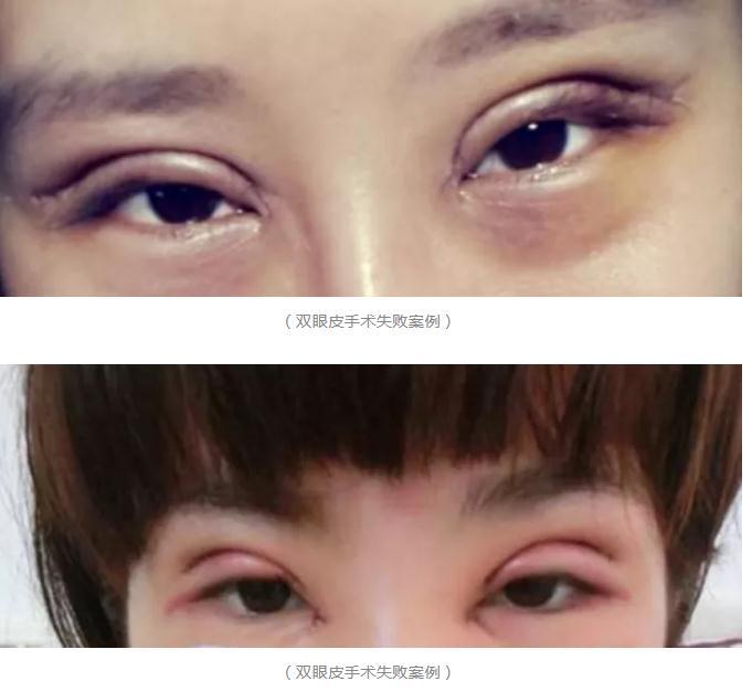 双眼皮会失败吗