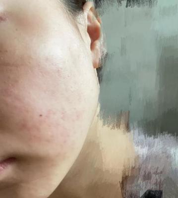 挤完痘痘留下红印