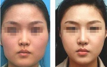 脸部吸脂费用是多少