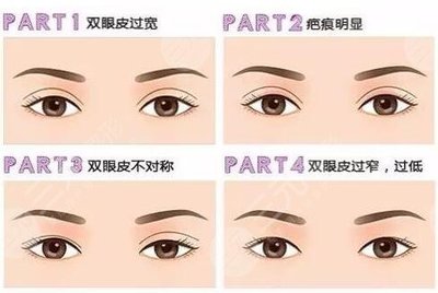 双眼皮怎么修复