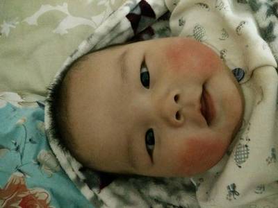 五个月宝宝出疹子怎么办