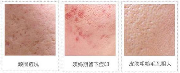 姨妈期起痘痘的原因