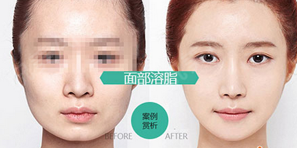 面部吸脂瘦脸效果好吗