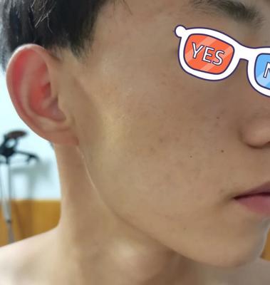 长痘痘后留下的红印