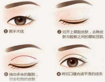割完双眼皮睁眼运动