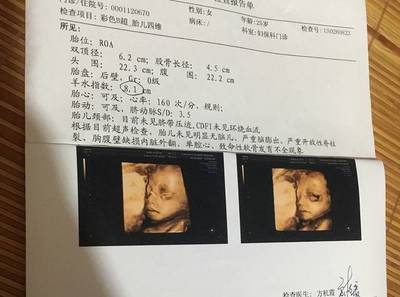 7个月引产