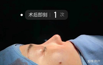 耳软骨隆鼻是永久的吗