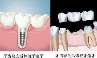 什么情况下做烤瓷牙