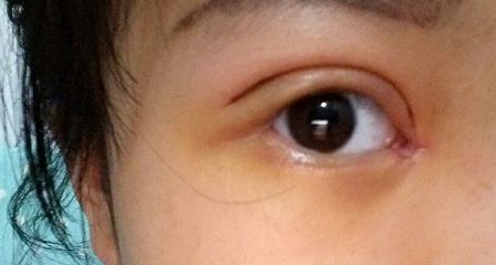 双眼皮抽线怎么抽