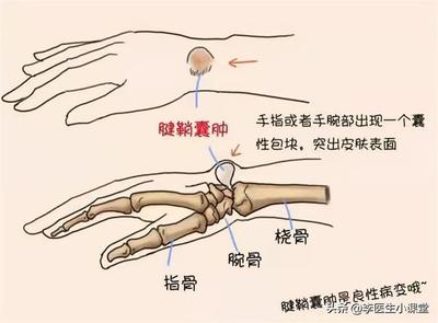 什么是腱鞘炎怎么治疗