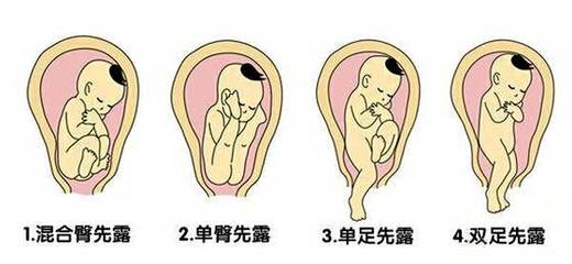 宝宝在肚子里的姿势
