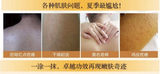 夏季痘痘皮肤用什么水