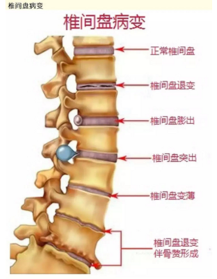 腰椎响是怎么回事