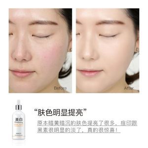 痘痘肌肤可以用精华液吗