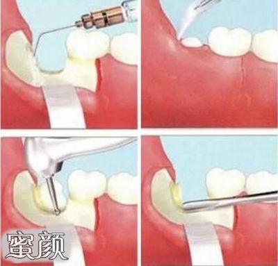 牙齿做牙周手术多少钱
