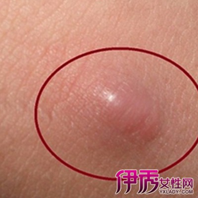 皮外囊肿怎么治疗