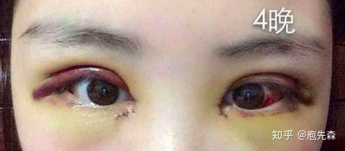 全切双眼皮多久完全消肿
