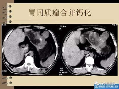 胃间质瘤是怎么回事