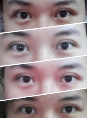 双眼皮太肿