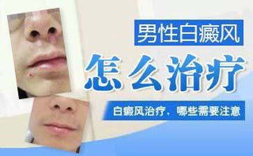 白癜风该怎么治疗好