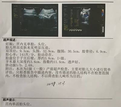 胎儿头位是入盆了吗
