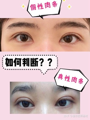 双眼皮疤痕多久才淡化