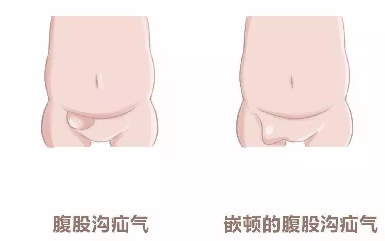 小儿疝气是怎么回事