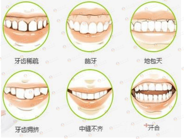 上牙龅牙的女生面相