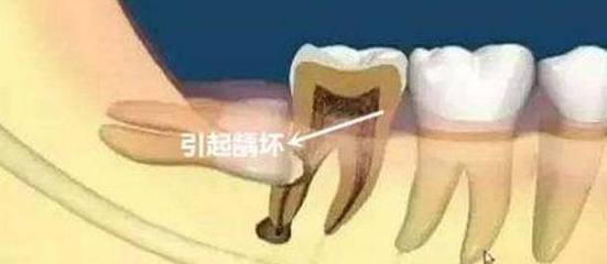 为什么拔牙
