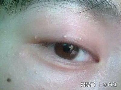 新生儿脸上有脂肪粒