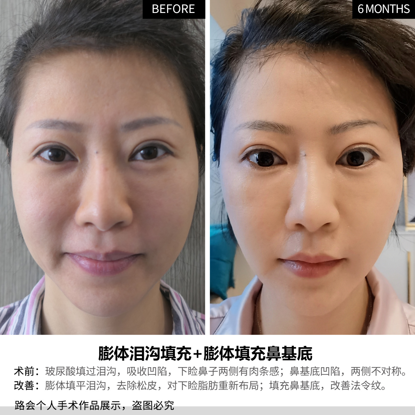 法令纹一边打0.5玻尿酸