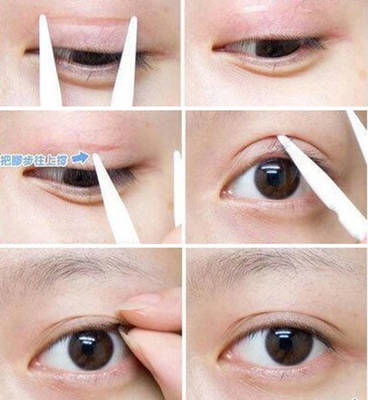 粘合双眼皮缺点