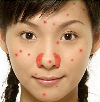 女人痘痘是指哪里