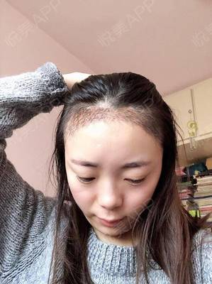 一个月头发能长多少厘米
