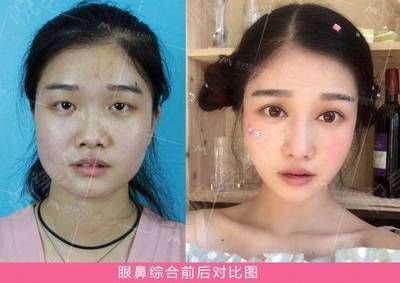 双眼皮疤痕多久才淡化