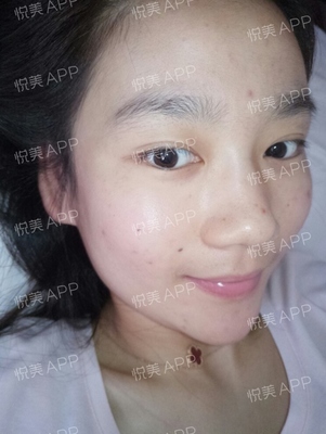 祛痘痘痘印的app软件